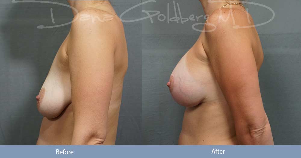 Breast Augmentation, Breast Lift - Side View